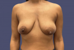 Breast Lift w/Augmentation 8 Before